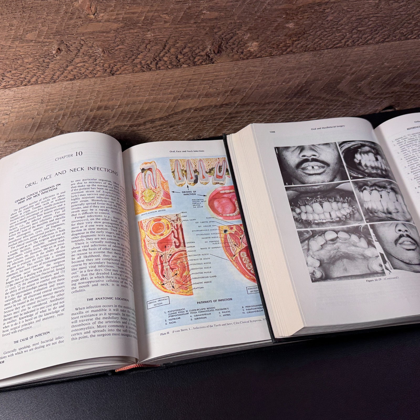 Oral and Maxillofacial Surgery ARCHER Fifth Edition Vol 1 & 2, 1975 – Saunders