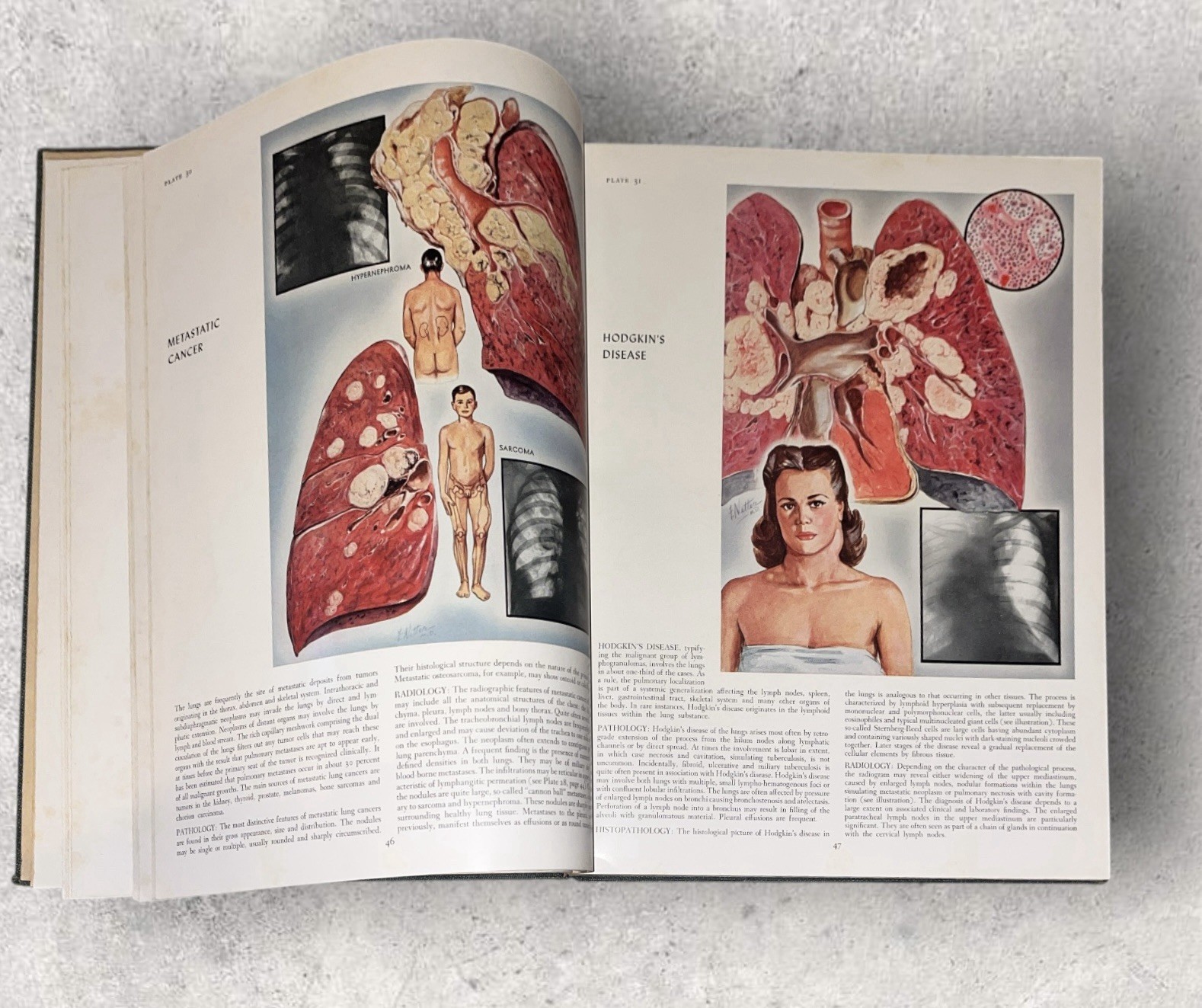 1st Edition THE CIBA COLLECTION OF MEDICAL ILLUSTRATIONS Frank H Netter MD 1948